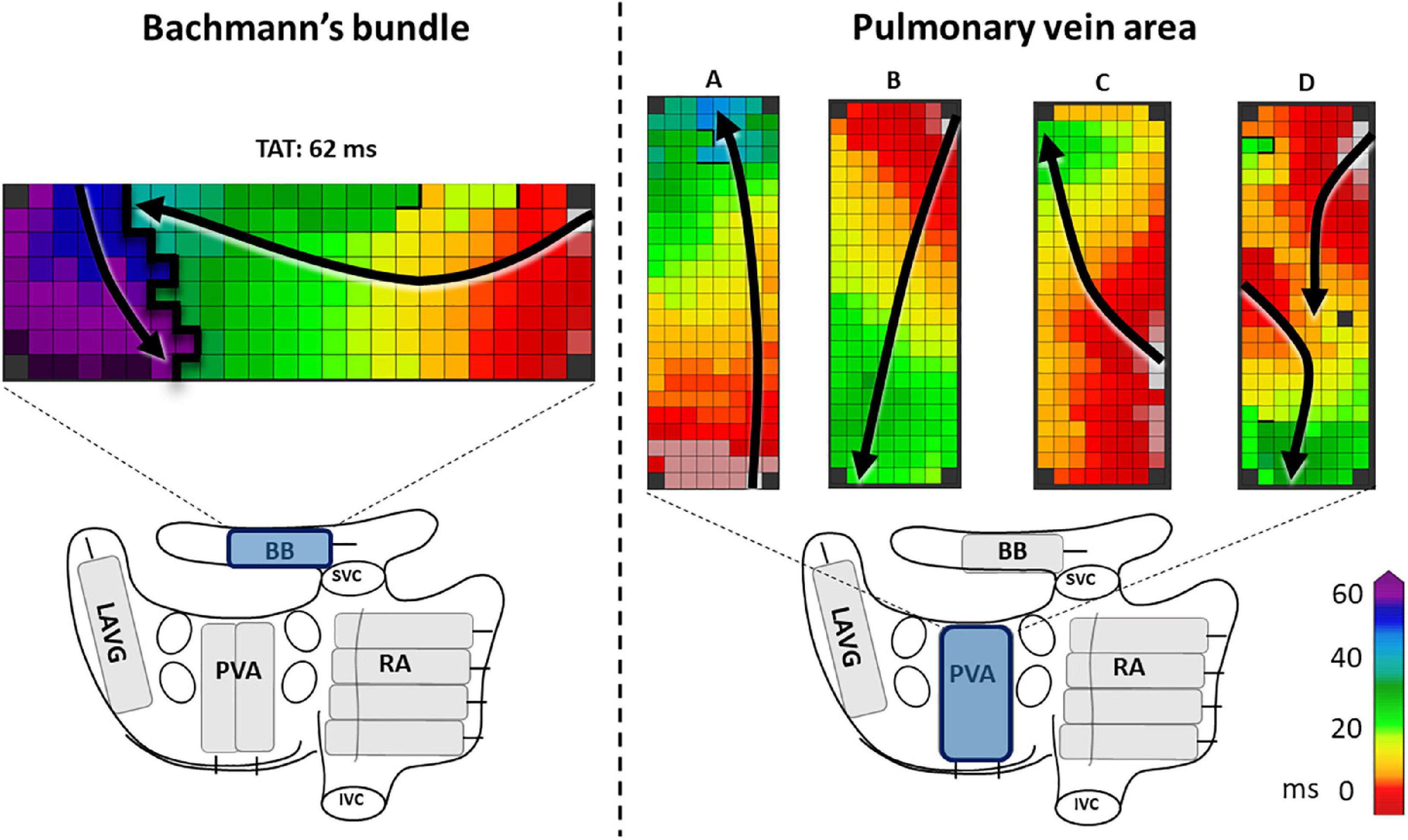 Epicardial high-resolution mapping of advanced interatrial block: Relating ECG, conduction abnormalities and excitation patterns